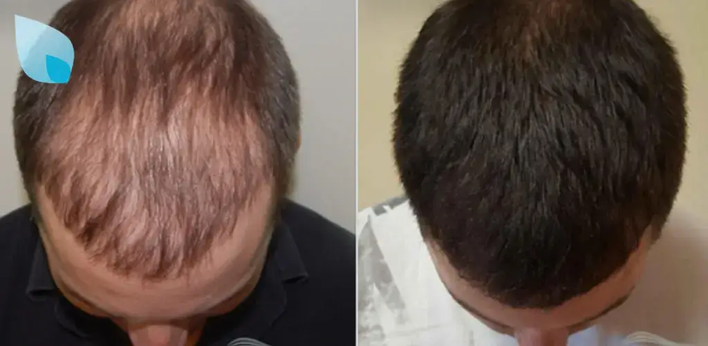 Alopecia-e-Genetica.webp