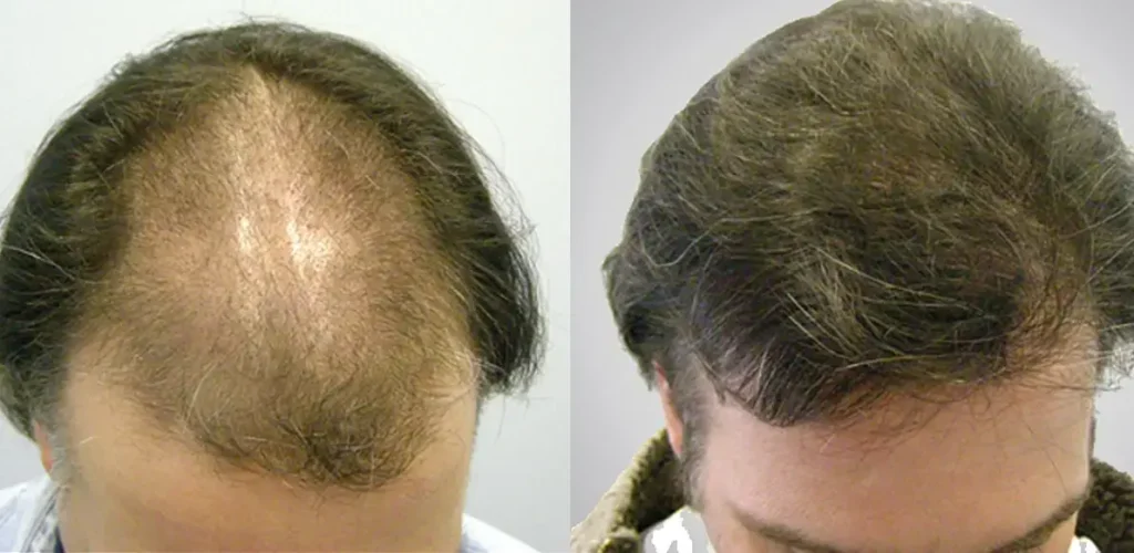 TRapianto-di-Capelli-e-Medicina-Rigenerativa.webp