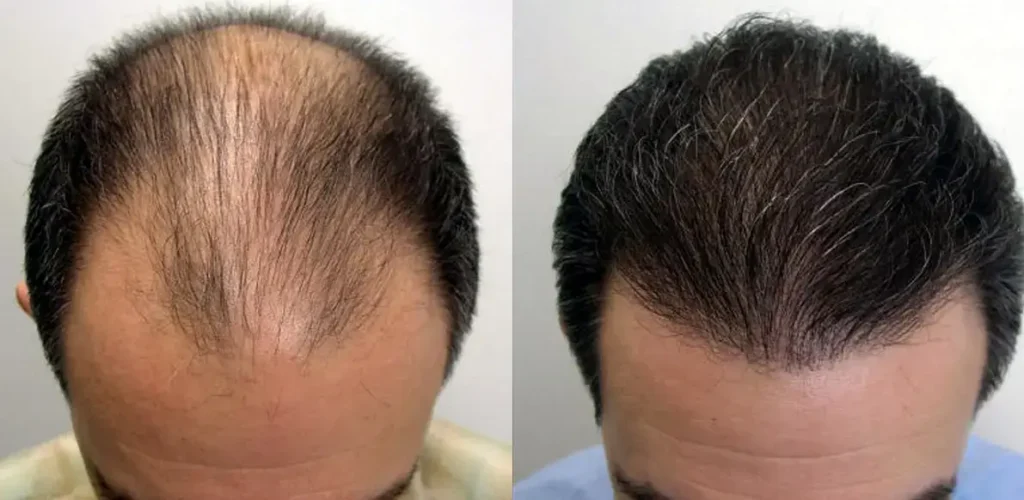 Trapianto-Capelli-Prima-e-Dopo.webp